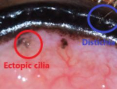 DistichiaEctopic Cilia