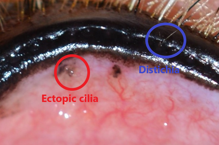 distichia-and-ectopic-cilia